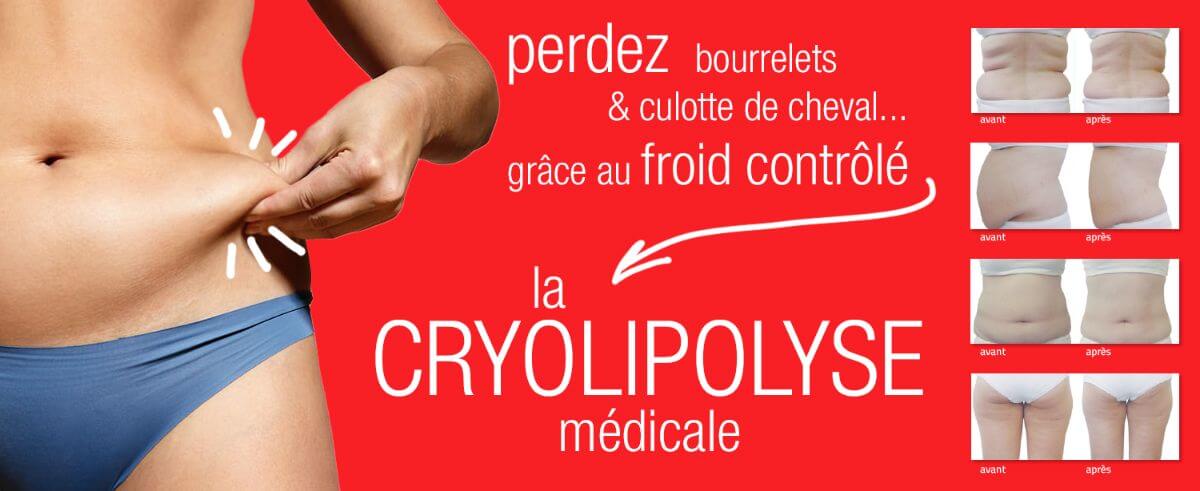 cryolipolyse